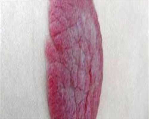 多囊卵巢患者促排后卵泡萎缩怎么办？