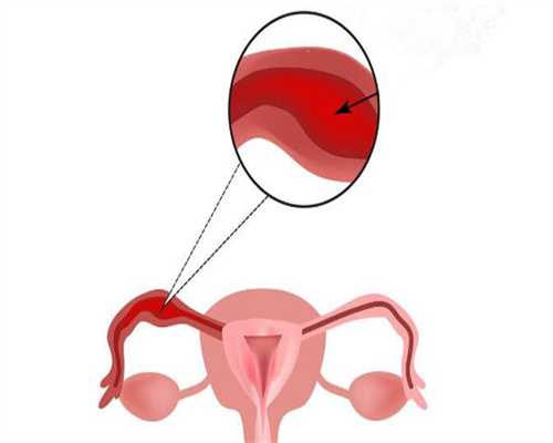 移植9天后有褐色分泌物，hcg升高，雌二醇只有3.97是宫外孕吗？