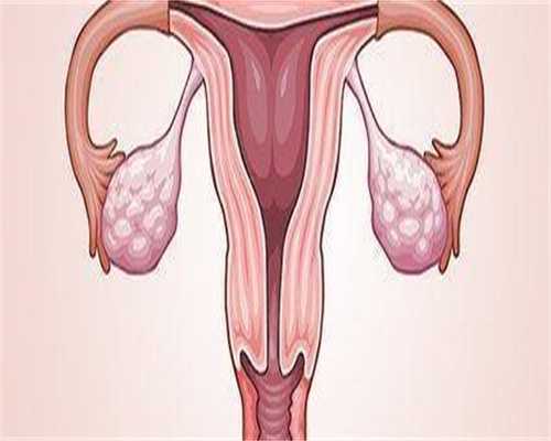 代生男孩中介：如何预防子宫肌瘤！子宫肌瘤的前期症状有哪些！