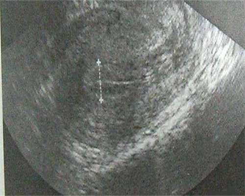 基础卵泡多少个算正常？ 怀孕初期还有卵泡吗？