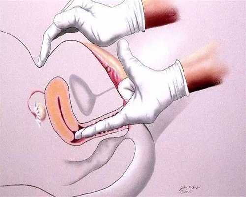 子宫腺肌症ca125