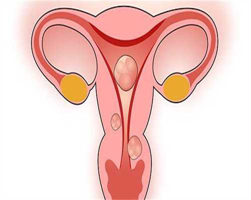 做试管阴道囊肿有影响吗,试管后卵巢囊肿原因引起的