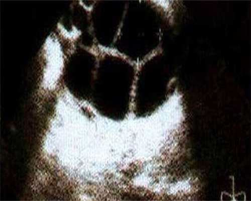 外阴炎的症状有哪些应该怎样治疗外阴炎