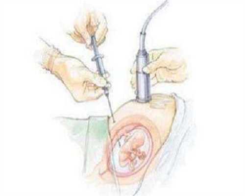 子宫畸形影响不孕的原因是什么