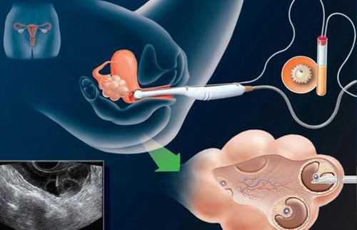 试管胎停多久可做二胎手术,试管胎停多久可以再做试管！