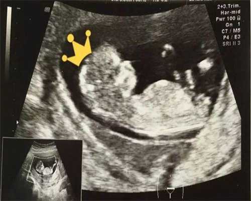 最佳代生网:试管移植后第9天可以吃清淡的菌汤火锅吗？试管移植饮食注意什么？