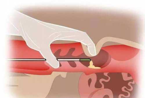 子宫囊肿影响生育吗