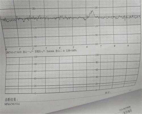 男性生育能力和Y染色体微缺失,AZFc微缺失