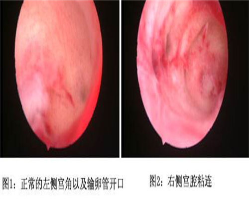 女人尿酸高可以在株洲试管要孩子吗？女性尿酸很高试管移植？