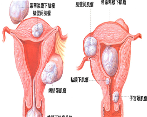 通常试管移植放胚胎的位置是不是固定放在宫腔中部的位置？