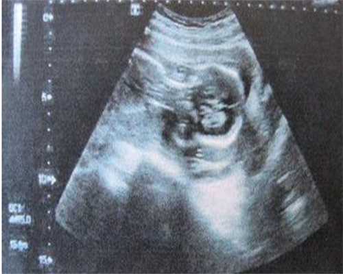 醋酸甲羟孕酮片的功效与作用？醋酸甲羟孕酮片的作用和功效