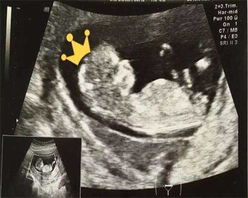 人流后宫腔粘连的症状有哪些?你知道它是怎样的症状吗?