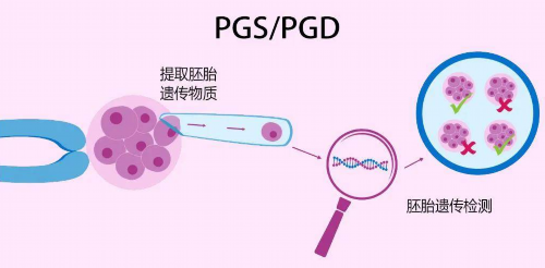 代生儿子收费:子宫偏小有什么表现(子宫偏小可以做试管吗)